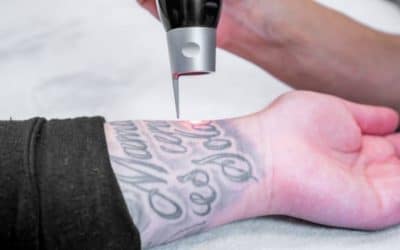 ¿Se puede eliminar totalmente un tatuaje? – Todo al respecto